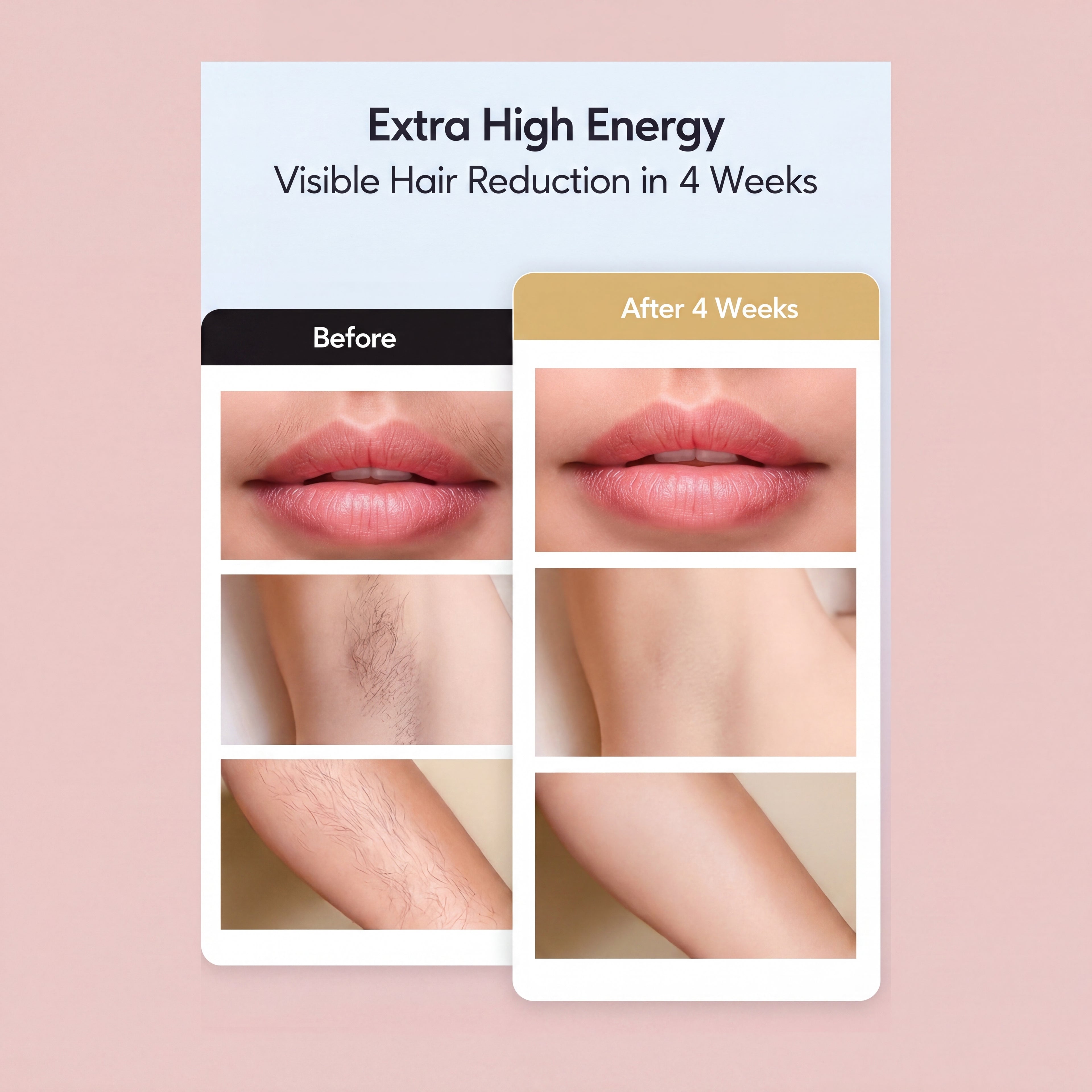 Velisse™ – IPL Hair Removal System